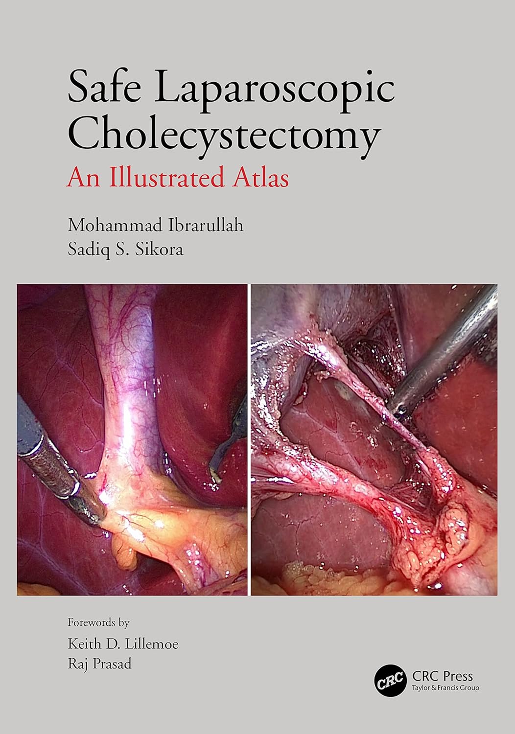 Buy Safe Laparoscopic Cholecystectomy: An Illustrated Atlas (English, Paperback, Mohammad Ibrarullah, Sadiq S Sikora) Online at Best Price - GlowMirror